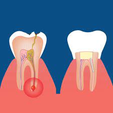 What is a Root Canal?  Root Canal Blogging & RCT Discussion